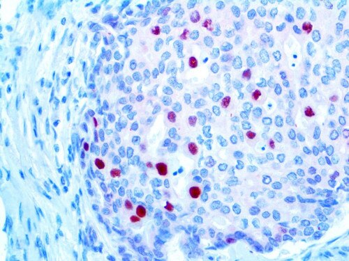 IHC of p21 on an FFPE Colon Carcinoma Tissue